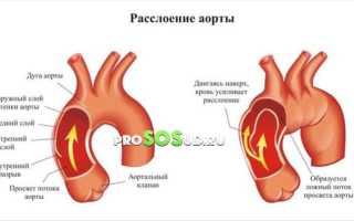 Расслоение аорты: клиническая картина, разновидности, диагностика и лечение заболеваний сердца