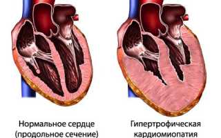 Гипертрофическая кардиомиопатия и ее последствия: важные аспекты здоровья