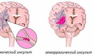 Что такое цереброваскулярная болезнь (ЦВБ) и её последствия