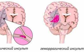 Что такое цереброваскулярная болезнь (ЦВБ) и её последствия