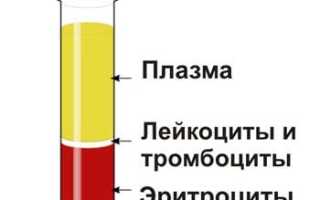 Что такое синдром ускоренного СОЭ и его последствия
