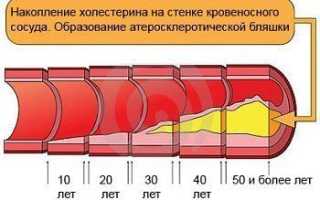 Питание при атеросклерозе сосудов: советы и рекомендации