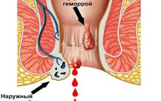 Почему кровит геморрой во время беременности, что делать?