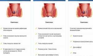 Проявления геморроя: перечень характерных симптомов