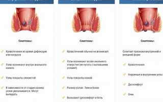Проявления геморроя: перечень характерных симптомов