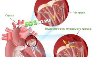 Митральная недостаточность сердца: причины, проявления и лечение для пациентов