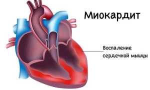 Причины миокардита и лечение: важные аспекты здоровья