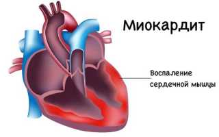 Причины миокардита и лечение: важные аспекты здоровья