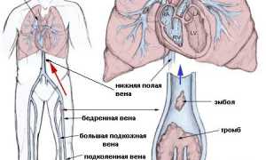 Лечение тромбоэмболии легочной артерии (ТЭЛА) у пациентов