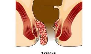 Как вылечить геморрой третьей степени?