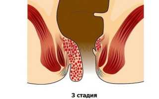Как вылечить геморрой третьей степени?