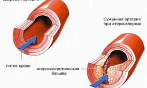 Сужение сосудов головного мозга: причины и последствия