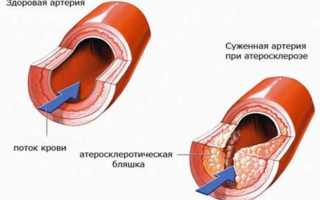 Сужение сосудов головного мозга: причины и последствия