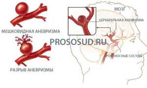 Восстановление кровотока в мозгу с помощью шунтирования для улучшения здоровья