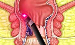 Удаление геморроидальных узлов лазером: подготовка и проведение операции