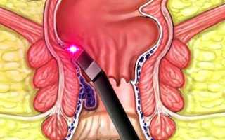 Удаление геморроидальных узлов лазером: подготовка и проведение операции