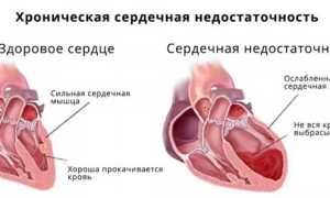 Что такое хроническая сердечная недостаточность и её причины