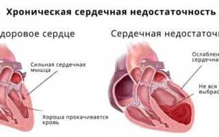 Что такое хроническая сердечная недостаточность и её причины