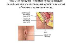 Как остановить кровотечение при анальной трещине: советы врачей