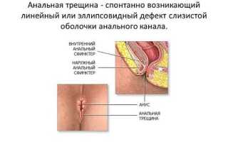 Как остановить кровотечение при анальной трещине: советы врачей