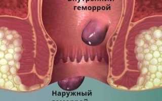 Почему возникает геморрой у женщин и как его лечить?
