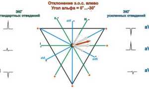 Отклонение ЭОС влево: причины, симптомы и лечение у пациентов