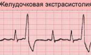 Что такое желудочковая экстрасистолия и чем она опасна для здоровья