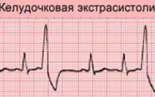 Что такое желудочковая экстрасистолия и чем она опасна для здоровья