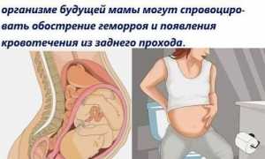 Как избежать геморроя во время родов: профилактика при беременности