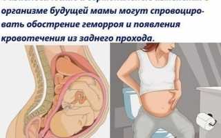 Как лечить геморрой во время беременности?