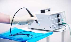 Аппарат Сургитрон для удаления геморроидальных узлов радиоволновым методом