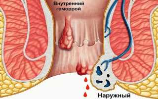 Чем лечить кровоточащий геморрой: препараты и средства для оказания помощи