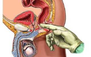 Что такое пальцевое или физикальное исследование прямой кишки?