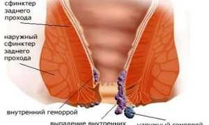 Как может выглядеть геморрой: фото по видам и стадиям у детей и взрослых