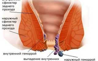 Как может выглядеть геморрой: фото по видам и стадиям у детей и взрослых