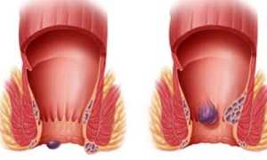 Код геморроя по Международной классификации болезней (МКБ-10)