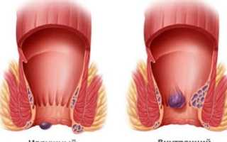 Код геморроя по Международной классификации болезней (МКБ-10)