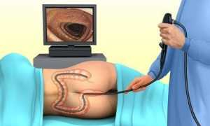 Методы обезболивания при проведении колоноскопии