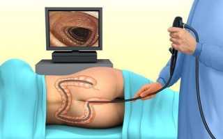 Методы обезболивания при проведении колоноскопии