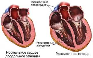 Что такое кардиомегалия, или «бычье сердце», и как с ней жить?