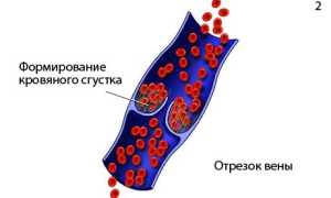 Флеботромбоз глубоких вен: причины и лечение