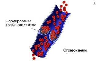 Флеботромбоз глубоких вен: причины и лечение