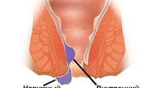 Что делать, если появился геморрой после родов?