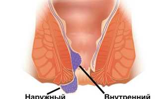 Геморрой и рак прямой кишки — в чем отличия заболеваний?