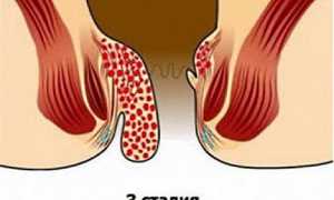 Какие виды операций по удалению геморроя существуют и сколько стоят хирургические вмешательства?