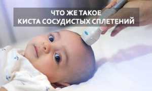 Кисты сосудистых сплетений головного мозга: причины и лечение