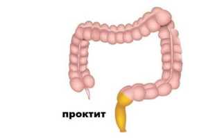 Что такое катаральный проктит?