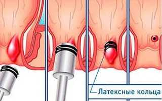 Что такое лигирование геморроя, как подготовиться к процедуре, возможные осложнения после операции