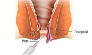 Плюсы и минусы склеротерапии геморроидальных узлов