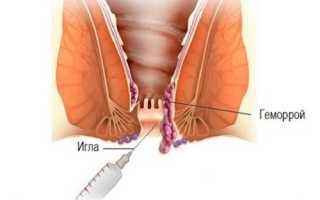 Плюсы и минусы склеротерапии геморроидальных узлов